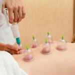 Cupping